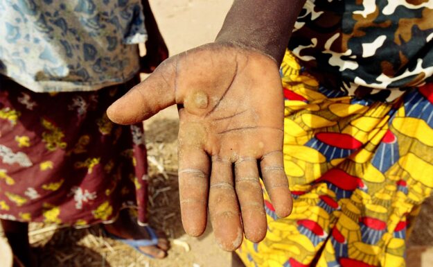 Hånden til en ung kvinne med vannblemmer etter hun har knust hirse i landsbyen Iskita i Niger.