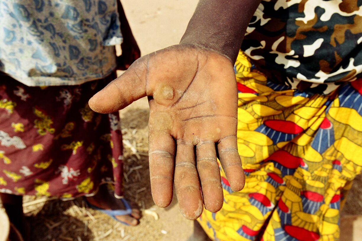 Hånden til en ung kvinne med vannblemmer etter hun har knust hirse i landsbyen Iskita i Niger. Foto: cn1433/ILO/M. Crozet.
